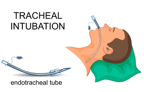 Tubo endotracheale