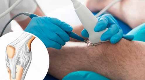 Intervento al ginocchio