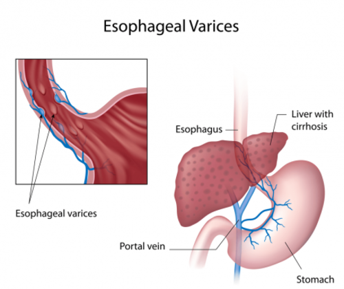 Varici esofagee: sintomi e trattamento