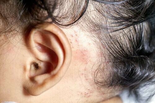 Psoriasi dietro l'orecchio