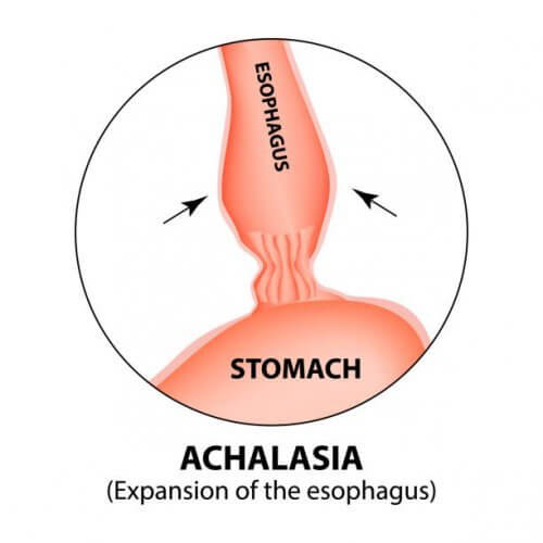 Schema acalasia