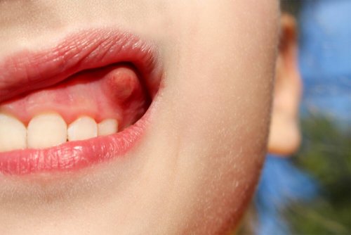 Ascesso dentale sulle gengive