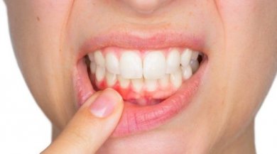 Ascesso dentale: che cos'è e come si cura