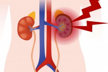 Vasculite: che cos'è e quali tipi esistono?