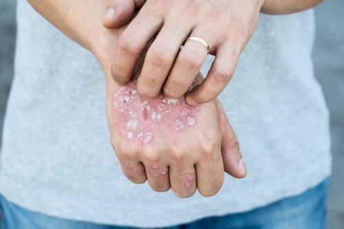 Donna con psoriasi sulla mano