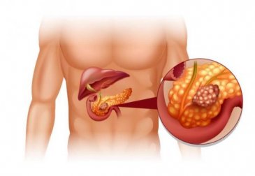 Tumori neuroendocrini pancreatici e trattamento