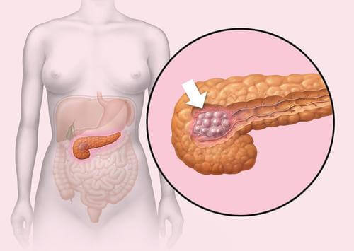 tumori neuroendocrini del pancreas asportabili