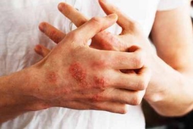 Alimenti per calmare la psoriasi, quali sono i migliori?