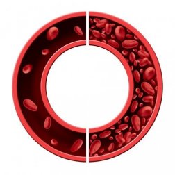 Trattare l'anemia sideropenica con rimedi naturali