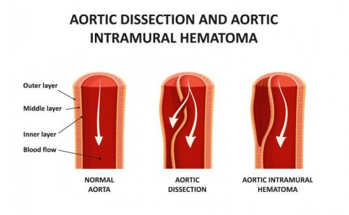Dettaglio di dissezione aortica