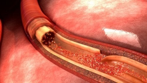 Dissezione aortica: cosa è e in cosa consiste