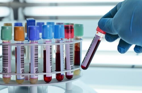 Analisi del sangue trombosi venosa profonda