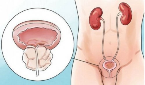 Infezione renale causata dal peegasm