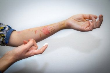 Ustioni superficiali: cure e primo soccorso