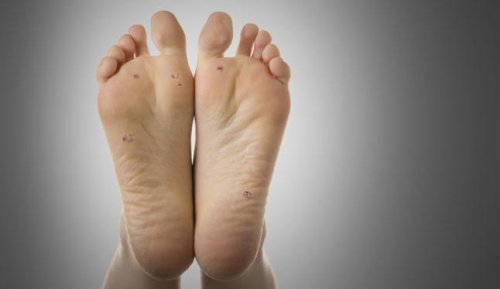 Punti neri su verruca.