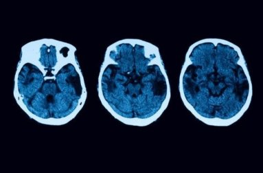 Atrofia corticale posteriore: diagnosi e trattamento
