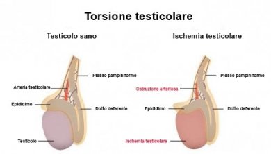 Torsione del funicolo spermatico: sintomi e cause