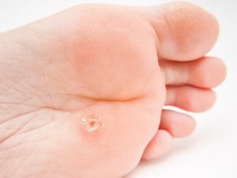 Verruca plantare: sintomi e trattamento