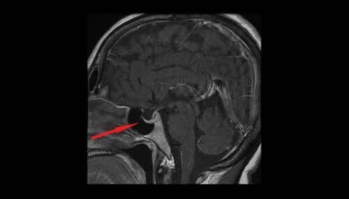 Adenoma ipofisario: cause e sintomi