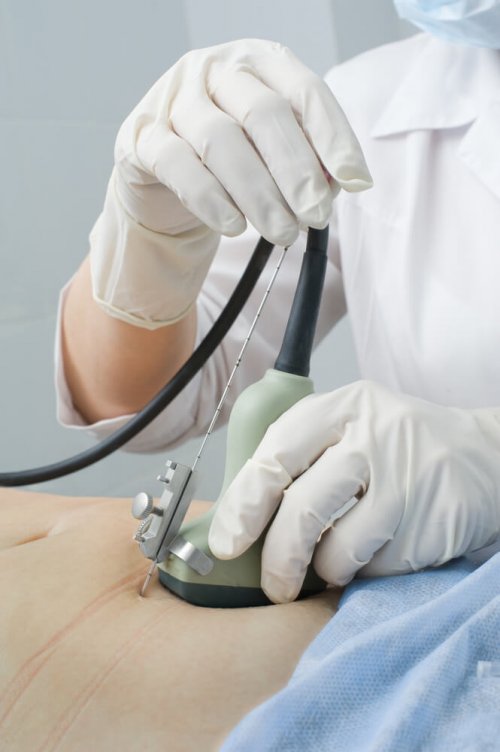 Amniocentesi dell'utero