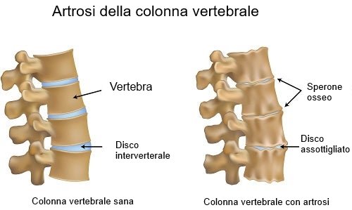 Artrosi della colonna vertebrale e colonna sana