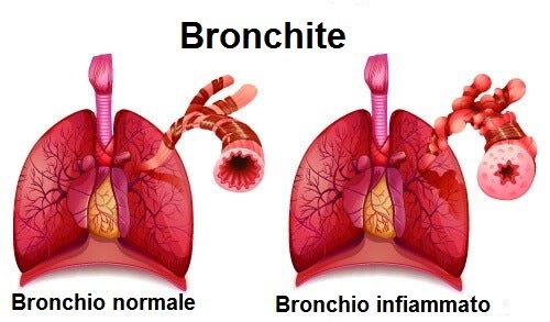 Tosse e dolore al petto possono essere dovute alla bronchite