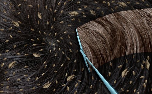 Capelli con lendini e pidocchi