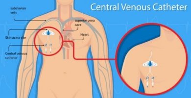 Perforazione vascolare da catetere centrale venoso
