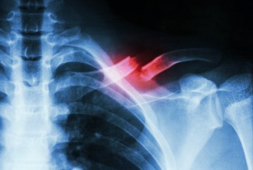 Radiografia di una frattura della clavicola
