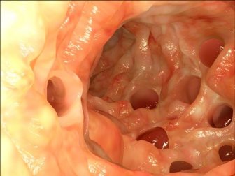 Il diverticolo di Meckel: diagnosi e caratteristiche