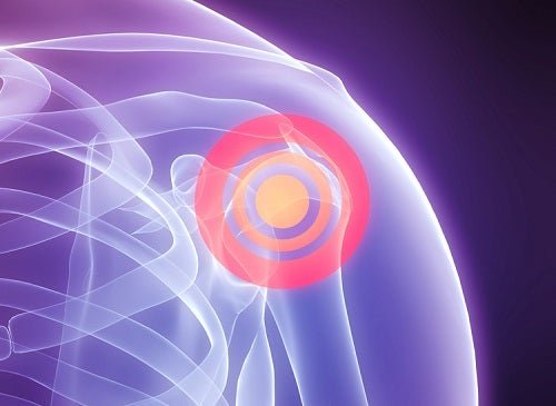 Dolore a causa della lesione della cuffia dei rotatori