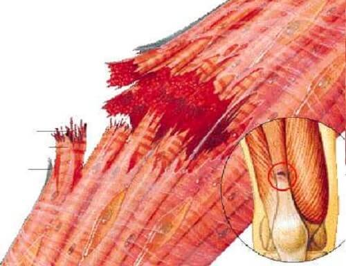 Strappo muscolare