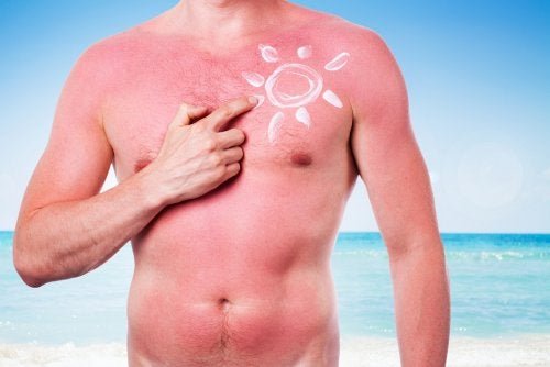 Uomo con scottatura solare sul corpo
