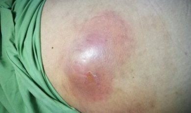 Ascessi intra-addominali: cosa sono?