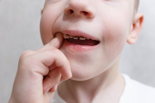 Bambino con una carie dentale