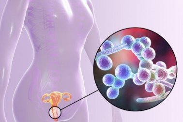 Candidosi vulvovaginale: tutto quello che c'è da sapere