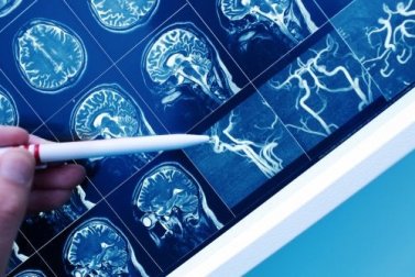 Demenza vascolare: come riconoscerla?