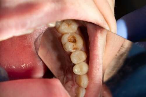 Carie dentale: come si forma e come prevenirla?