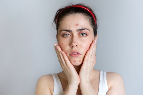 Ragazza con acne in viso