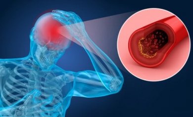 Apoplessia: sintomi e fattori di rischio