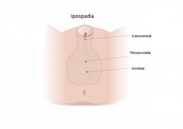 Ipospadia: sintomi, tipologie e trattamenti