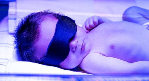 Iperbilurubinemia nel neonato