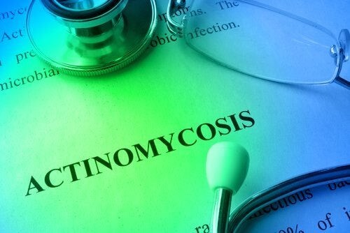 Actinomicosi: prevenzione e trattamento