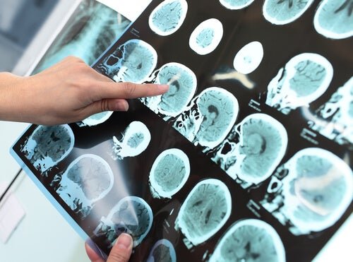 ARadiografia per l'Alzheimer