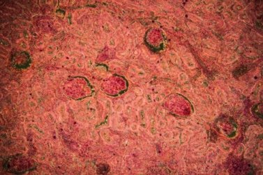 Tubercolosi renale: diagnosi e trattamento