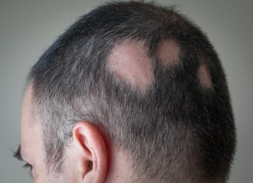 Alopecia areata e stress