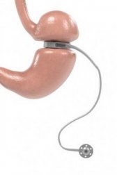 Bendaggio gastrico: di cosa si tratta?