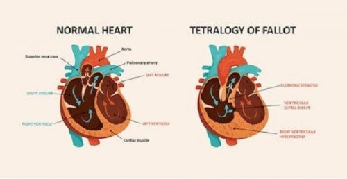 Confronto tra cuore sano e cuore con cardiopatia