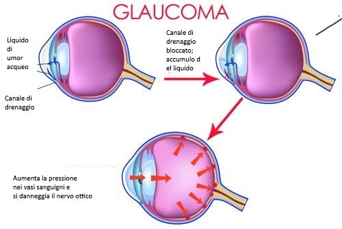 Descrizione del glaucoma