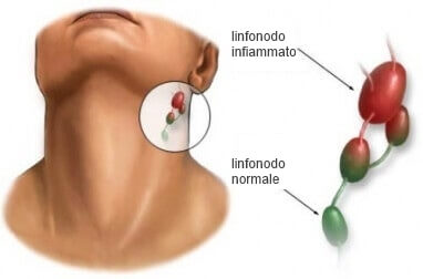 Linfonodi infiammati e normali